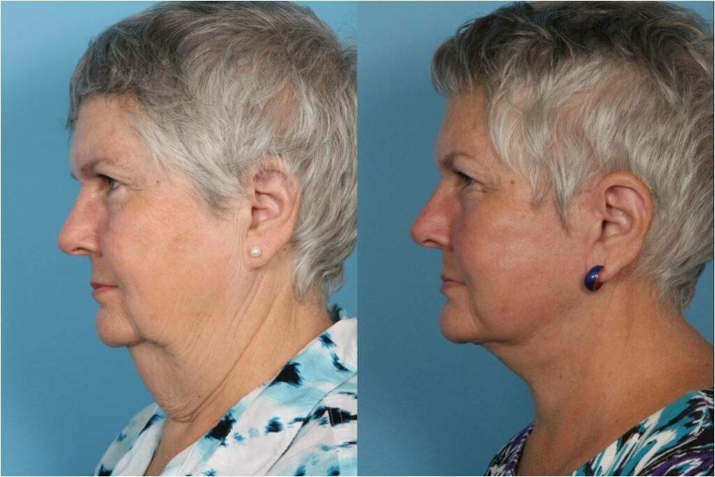 Facelift and Necklift