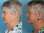 Facelift and Necklift