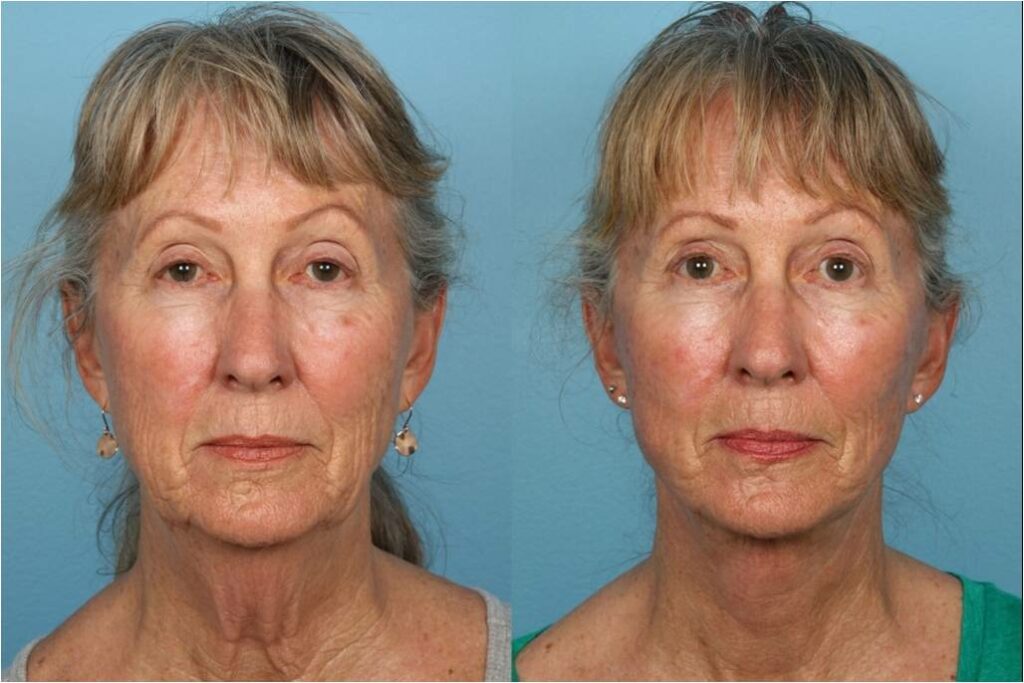 Facelift and Necklift