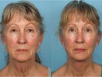 Facelift and Necklift