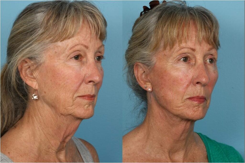 Facelift and Necklift