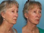 Facelift and Necklift