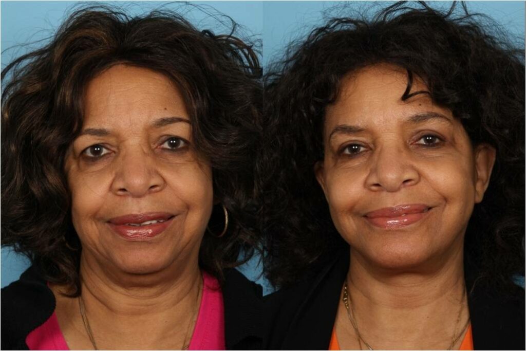 Facelift and Necklift