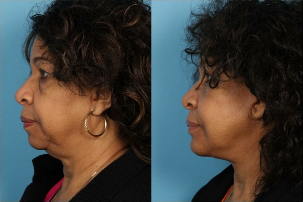 Facelift and Necklift