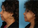 Facelift and Necklift