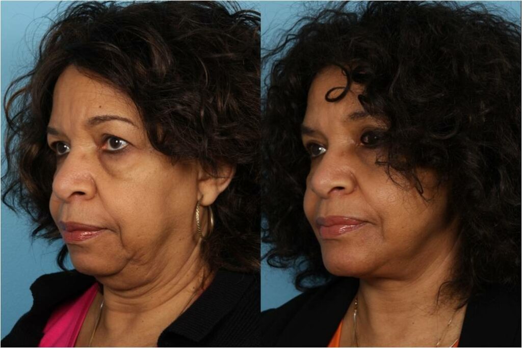 Facelift and Necklift