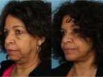 Facelift and Necklift