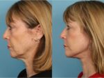 Facelift and Necklift