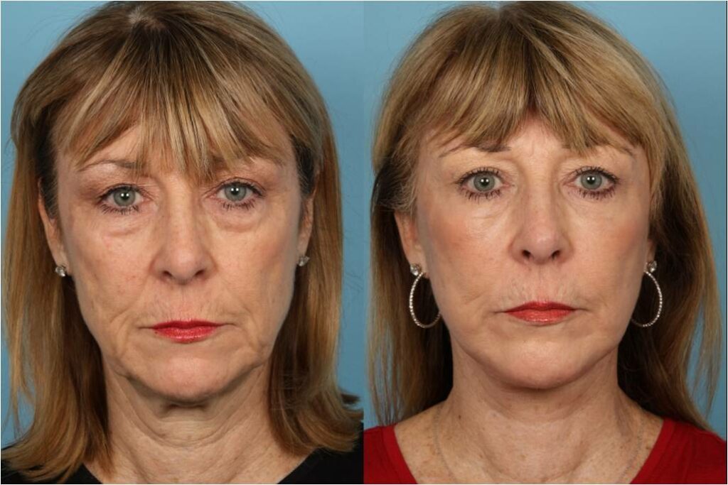 Facelift and Necklift