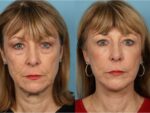 Facelift and Necklift