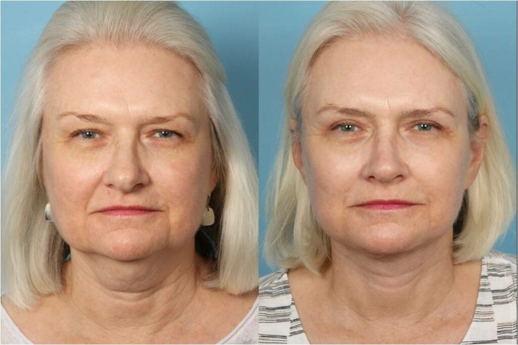 Facelift and Necklift