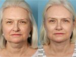 Facelift and Necklift