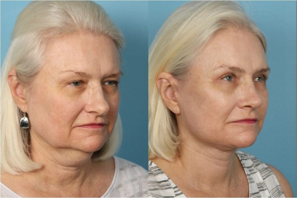 Facelift and Necklift