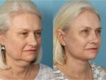 Facelift and Necklift