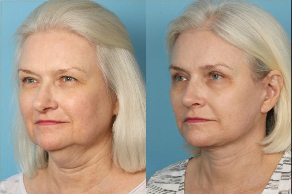 Facelift and Necklift