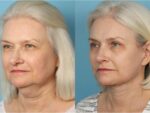 Facelift and Necklift