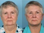 Facelift and Necklift