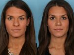 Rhinoplasty (Nose Job)