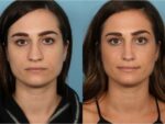 Rhinoplasty (Nose Job)