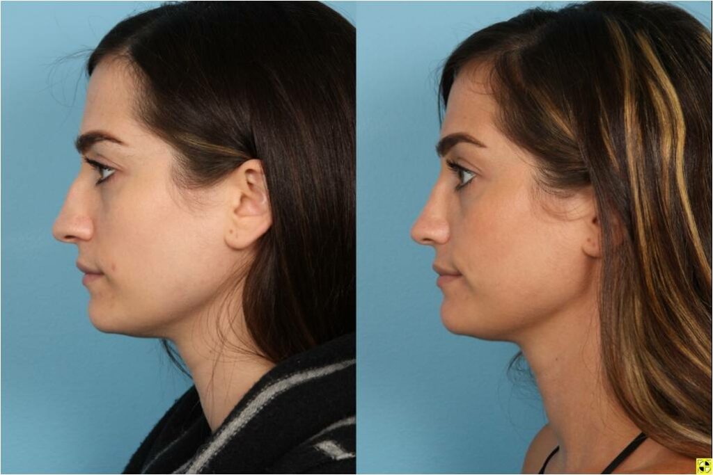 Rhinoplasty (Nose Job)