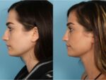 Rhinoplasty (Nose Job)