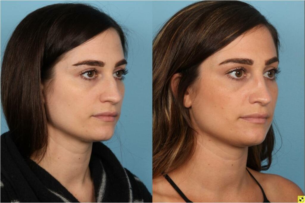 Rhinoplasty (Nose Job)