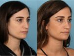 Rhinoplasty (Nose Job)