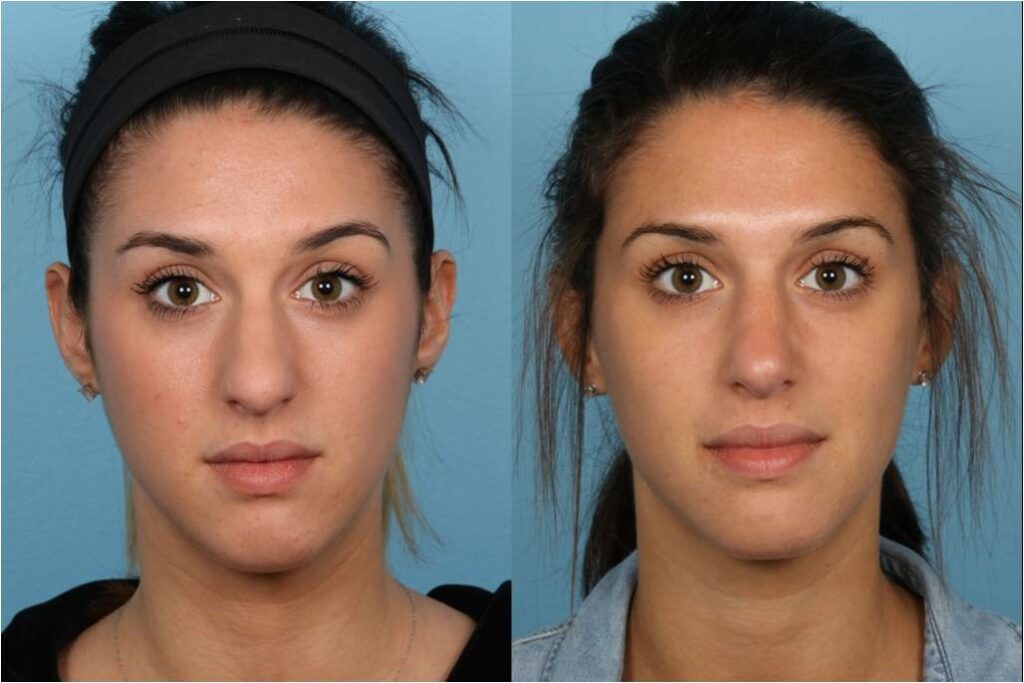 Rhinoplasty (Nose Job)