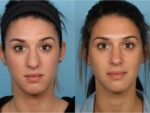 Rhinoplasty (Nose Job)