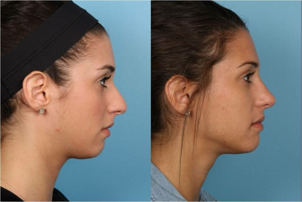 Rhinoplasty (Nose Job)