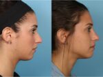 Rhinoplasty (Nose Job)