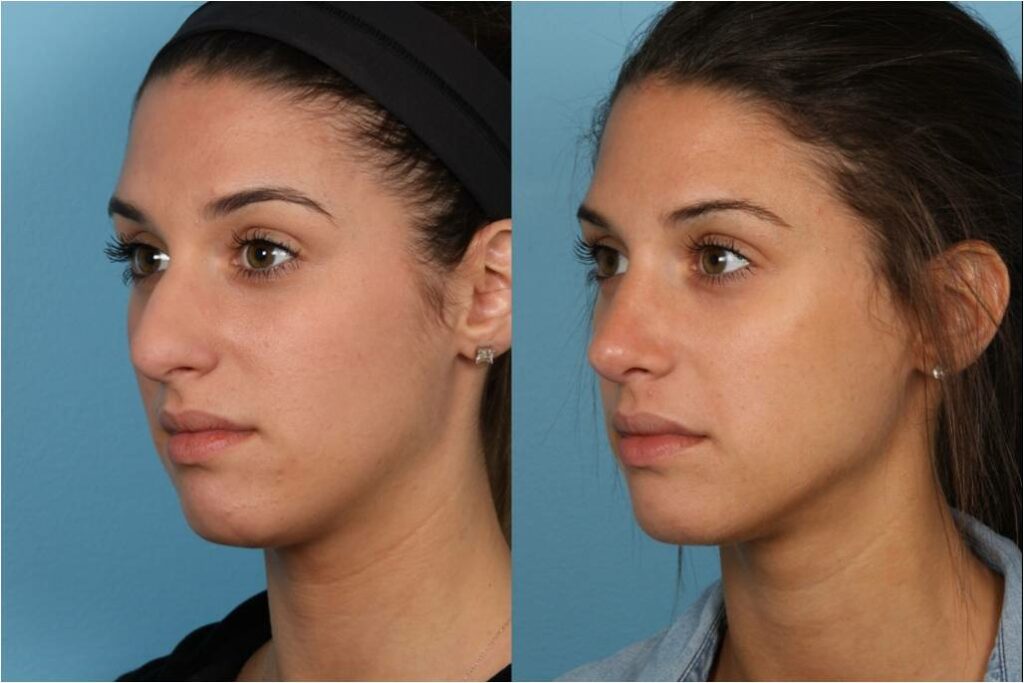 Rhinoplasty (Nose Job)