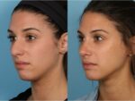 Rhinoplasty (Nose Job)