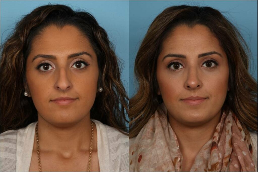 Rhinoplasty (Nose Job)