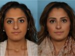 Rhinoplasty (Nose Job)