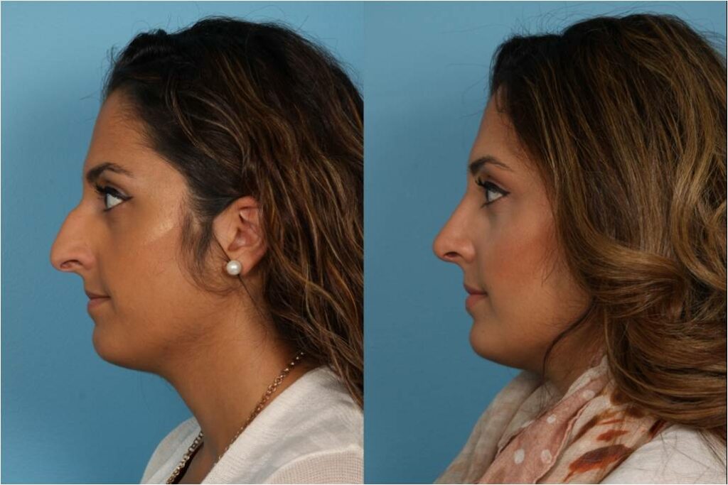 Rhinoplasty (Nose Job)