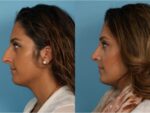 Rhinoplasty (Nose Job)