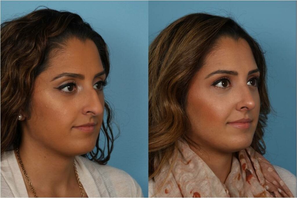 Rhinoplasty (Nose Job)