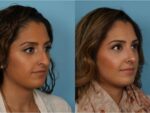 Rhinoplasty (Nose Job)