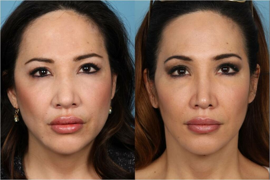 Rhinoplasty (Nose Job)