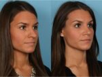 Rhinoplasty (Nose Job)