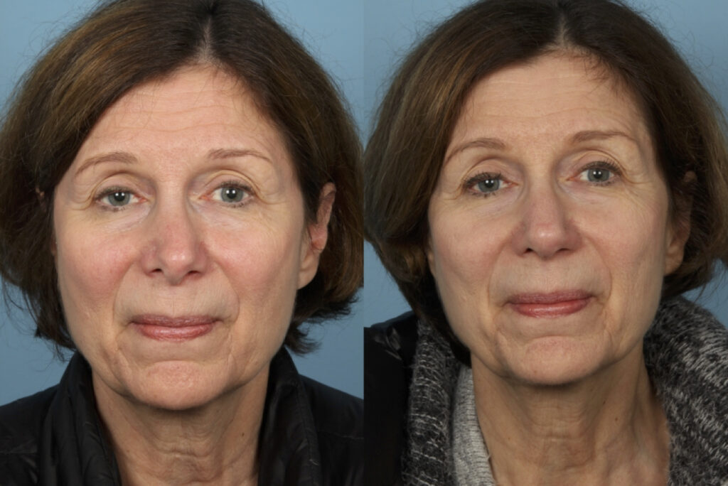 Rhinoplasty (Nose Job)