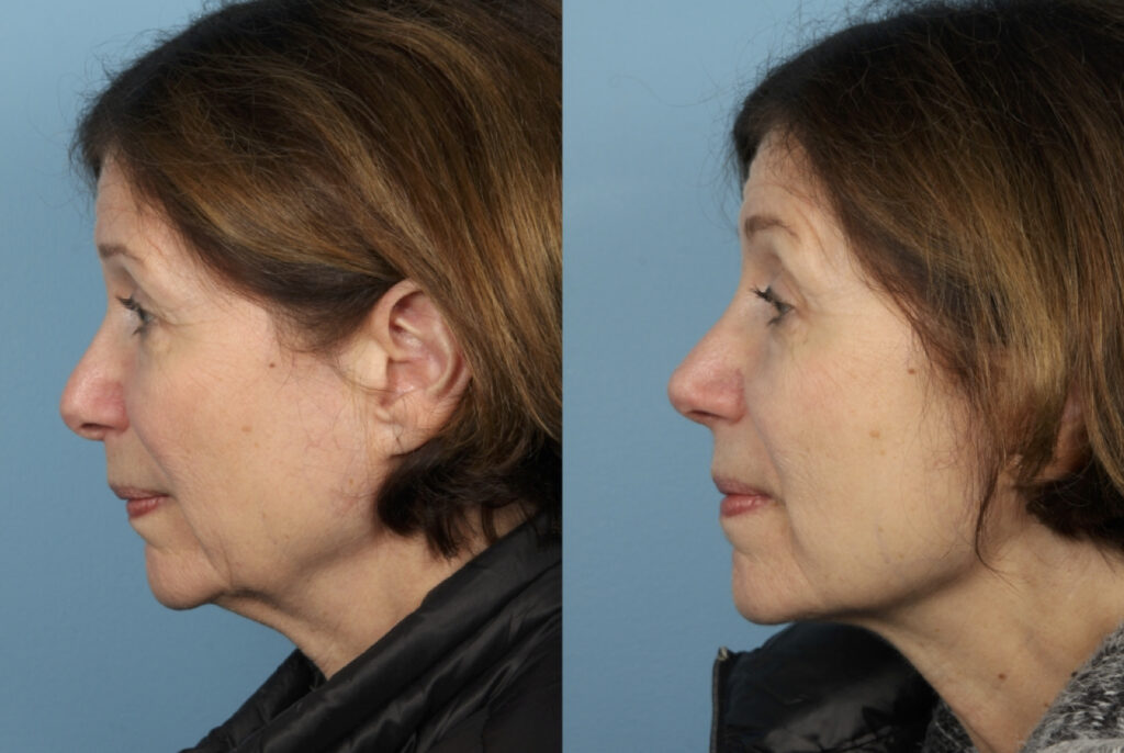 Rhinoplasty (Nose Job)