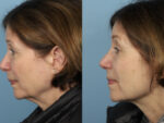 Rhinoplasty (Nose Job)