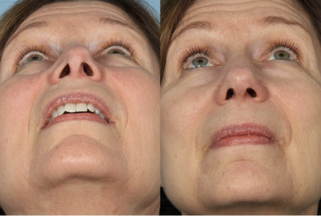 Rhinoplasty (Nose Job)