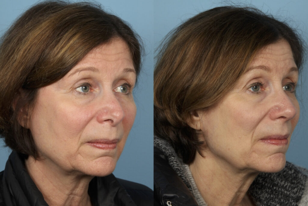 Rhinoplasty (Nose Job)