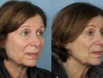 Rhinoplasty (Nose Job)