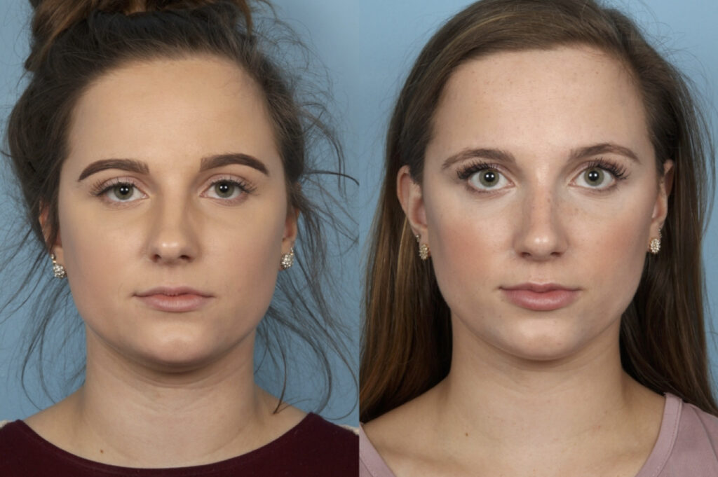 Rhinoplasty (Nose Job)