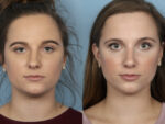 Rhinoplasty (Nose Job)