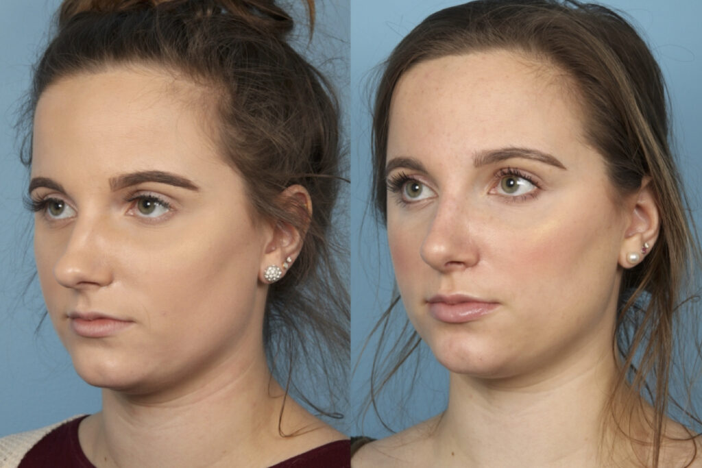 Rhinoplasty (Nose Job)